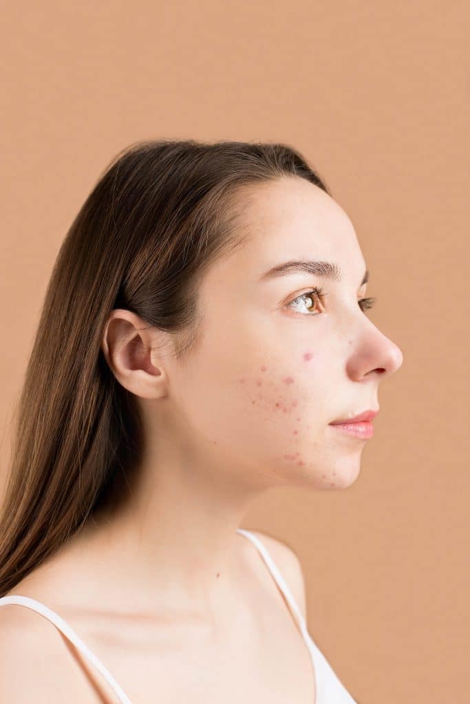 Quel savon utiliser contre l&rsquo;acné et les taches noires sur le visage ?